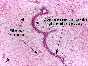fibroadenoma of breast