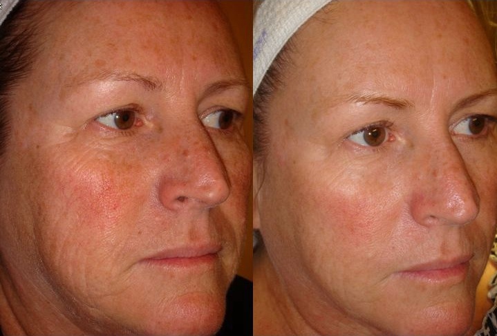[Dermasweep+Before+and+After.jpg]