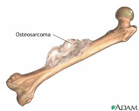 Penyakit Tulang, Sendi dan Otot: Tumor Tulang