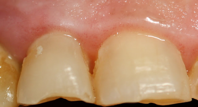 Studio dentistico dr. Alessandro Artese: Parodontologia