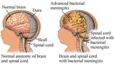 Pathophysiology of Meningitis