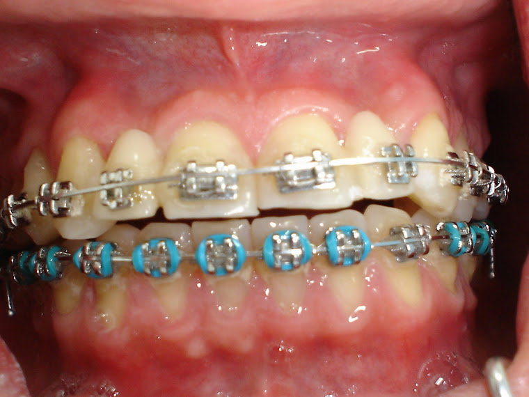 FOTO 3B - ORTODONTIA VISANDO IMPLANTES