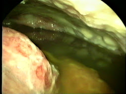 5.- MESOTELIOMA PERITONEAL MALIGNO