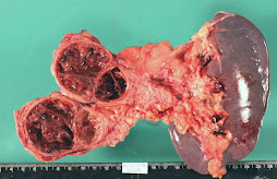 3.- TUMOR de FRANTZ