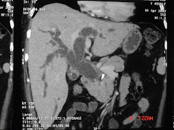 2.- COLANGIOCARCINOMA