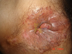 1.- HIV/SIDA y tumoración anorrectal