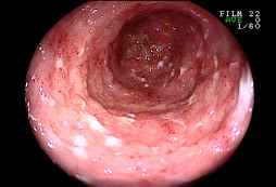 3.-ENFERMEDAD INFLAMATORIA INTESTINAL