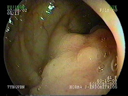 1.- ENDOMETRIOSIS COLORRECTAL