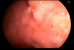 1.- Metaplasia gástrica en duodeno