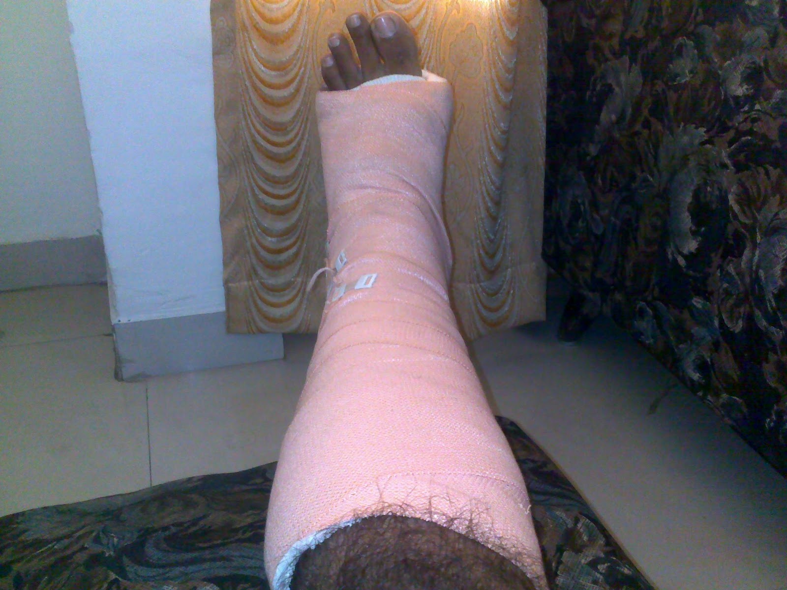 Just a Regular Blog Broken leg .. and before that