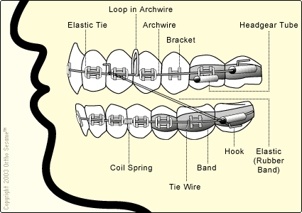 [Braces+Diagram.gif]