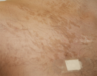 scars laser hair removal