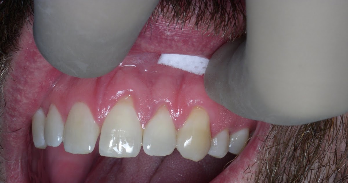 Periodontal Implant Cases by Dr. Thomas Kang Connective Tissue Grafts