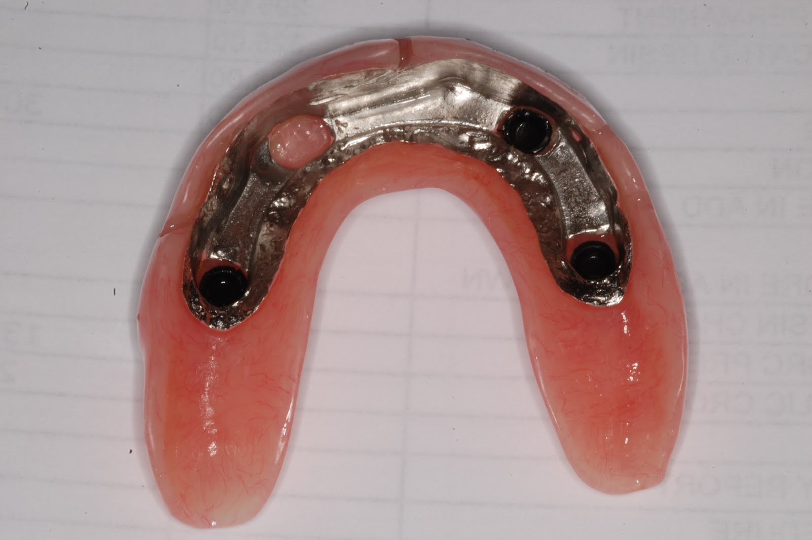 Periodontal Implant Cases by Dr. Thomas Kang A maxillary overdenture case
