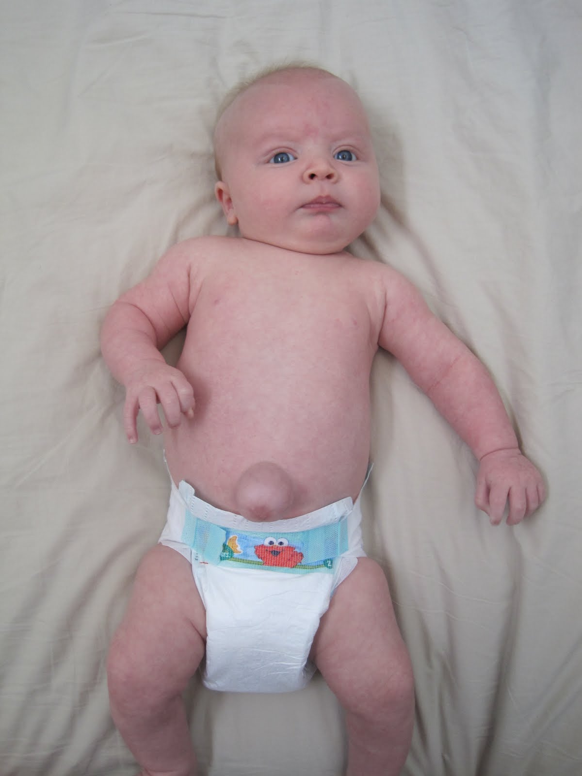 Ernia Blouse belly button hernia baby when to worry labzada blouse Ernia Blouse belly button hernia baby when to worry labzada blouse
