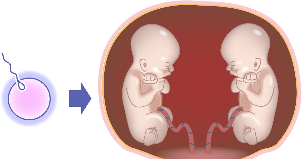 My Monoamniotic Twin Journey What are Monoamniotic Twins?