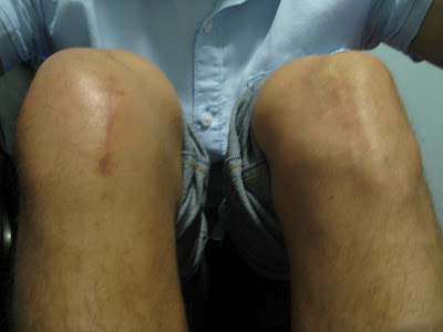 Acl Repair Surgery