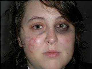 A victim of Red Sox-related violence!