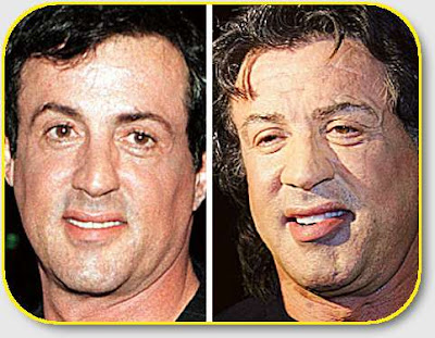 Cirugias plasticas Sylvester+Stallone