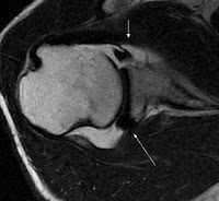 ct scan shoulder dislocation