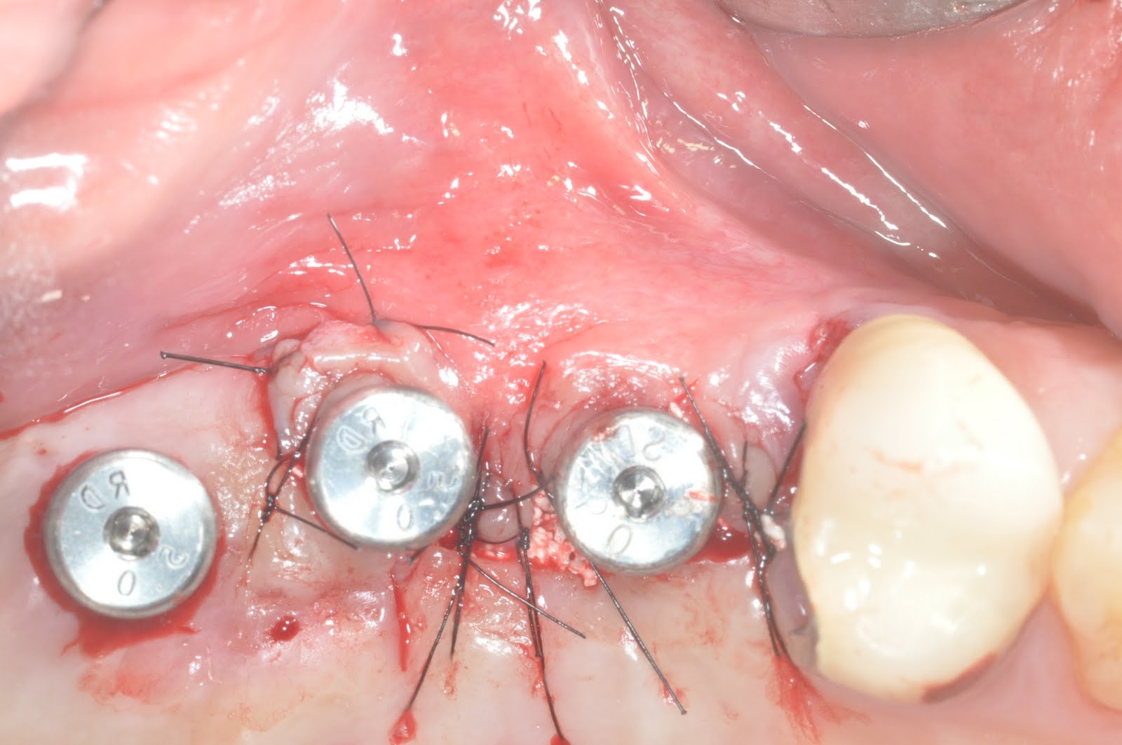 Dental implant professional Critical site management (9) Sinus