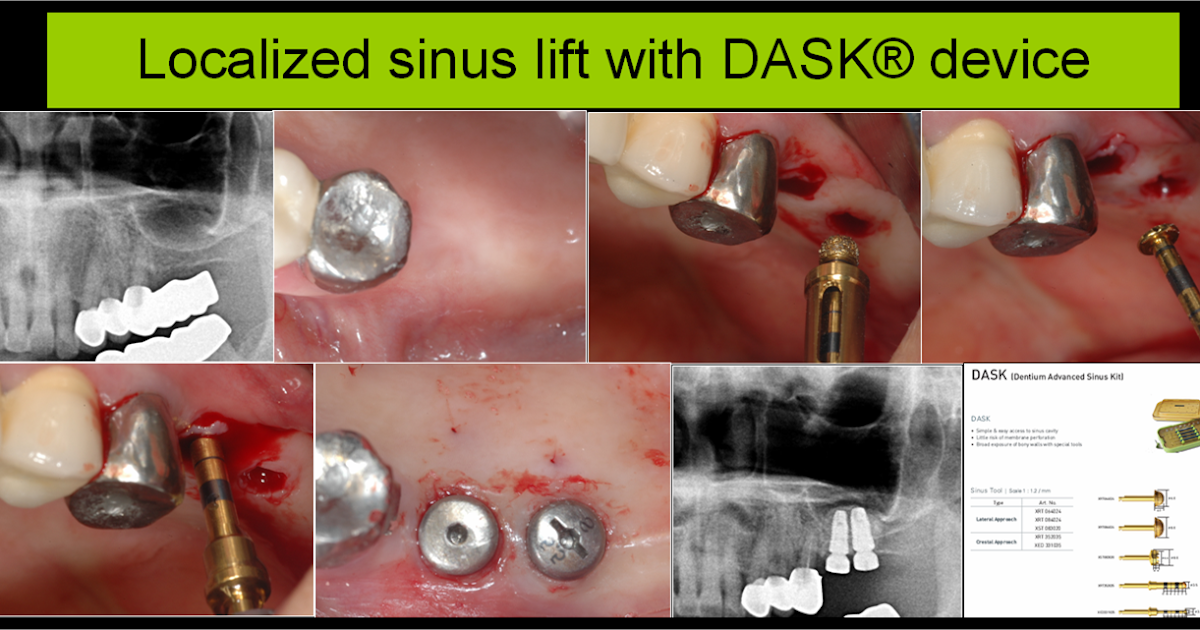 Dental implant professional Localized sinus lift with DASK device