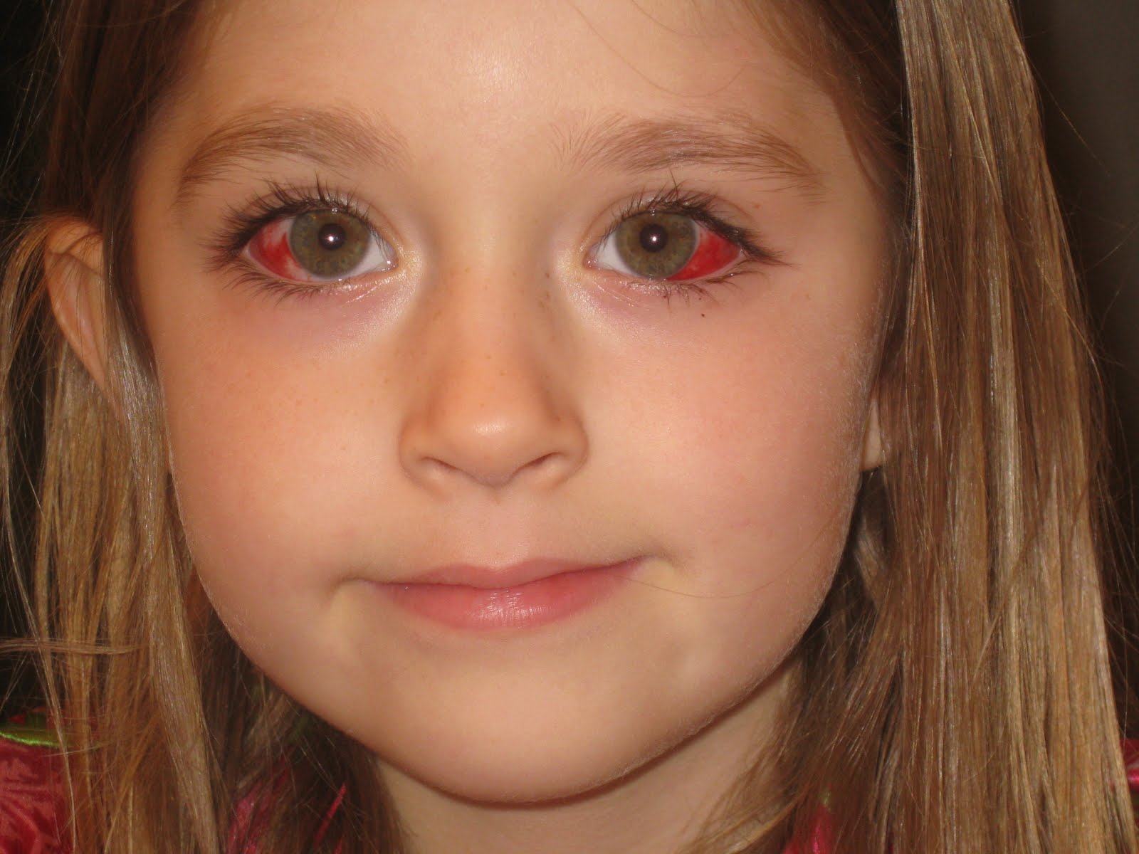 Why does strabismus appear in adults and how to be treated (from surgery to traditional methods) Why does strabismus appear in adults and how to be treated (from surgery to traditional methods)