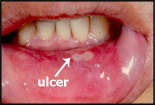 large mouth ulcer