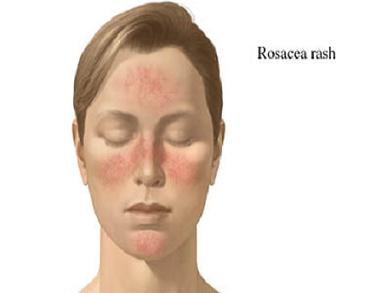 [Rosacea-+Tips+-Symptoms-Treatments-Prevention-+skin-disorder-+Causes-+Pain-Cures-Stages-Facts.jpeg]