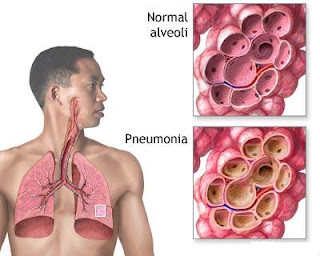 Pneumonia Symptoms