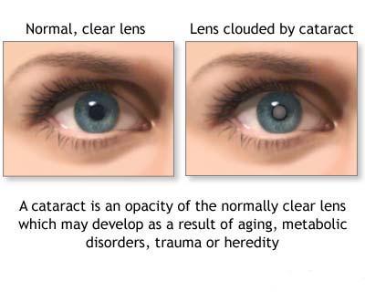 The term cataracts refer to a clouding of the eye's lens that is located The term cataracts refer to a clouding of the eye's lens that is located