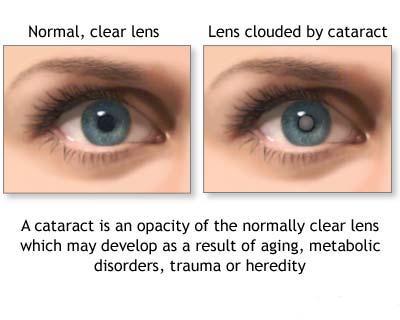 The term cataracts refer to a clouding of the eye's lens that is located 