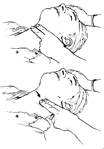 Tibial Pulse