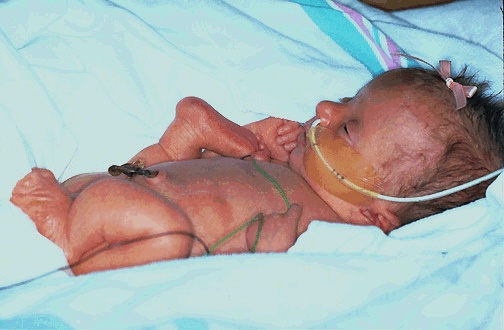 O eczema em pregos como curar