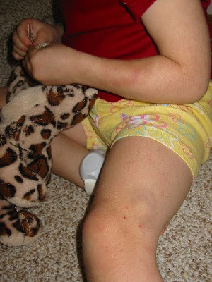 Self-inflicted bite bruises on Joy's arm and leg