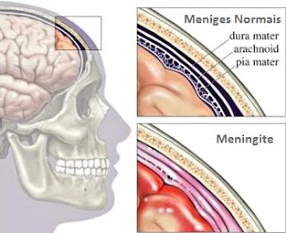 vacina meningite