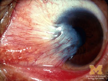 Pterygium+surgery