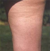 ways to get rid of cellulite
