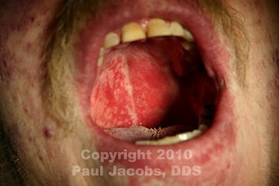 Pictures+of+Hard+Palate+Cancer Most apparent on the hard and soft palate are the bright red ...