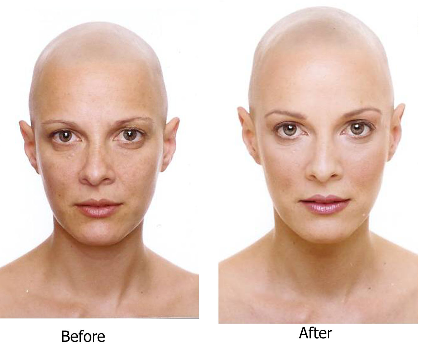 Breast Success Before And After Pictures