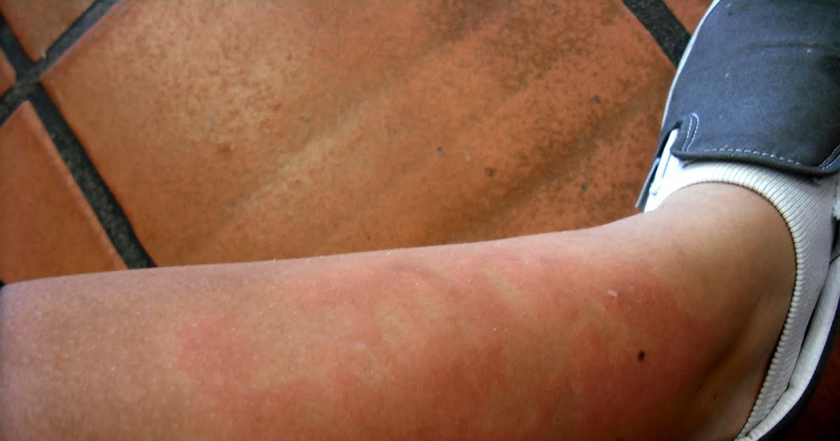 make a run for it Ice Burn