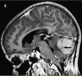 Xray of a really big medulloblastoma, a form of brain cancer