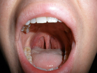 tonsils scabs