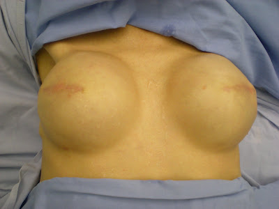Expanders breast cancer painful