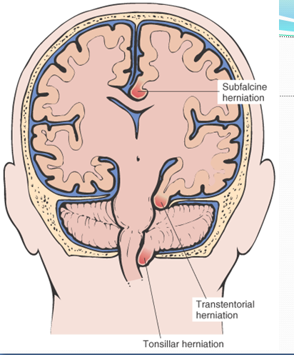 brain herniation