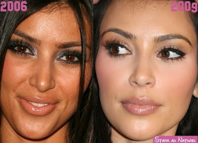kim kardashian chirurgie