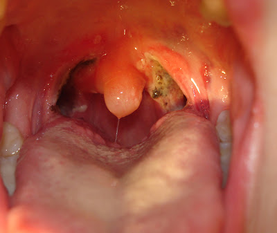 deep tonsils Xxx throat
