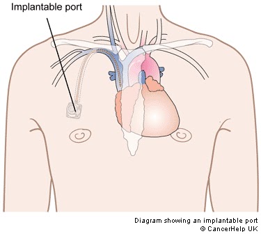 port placement