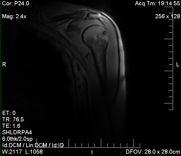 my frozen shoulder mri results