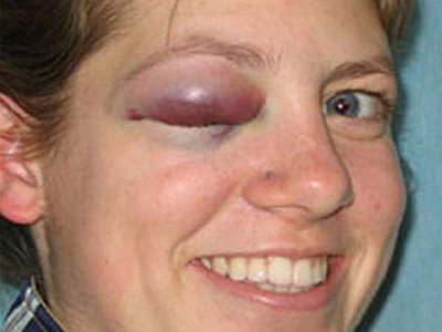 UN OJO MORADO un ojo morado: